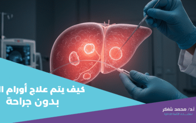 علاج أورام الكبد بدون جراحة .. كيف يتم ؟ الأشعة التداخلية لعلاج أورام الكبد