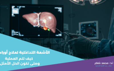 الأشعة التداخلية و علاج أورام الكبد كيف تتم العملية ومتى تكون الحل الأمثل؟